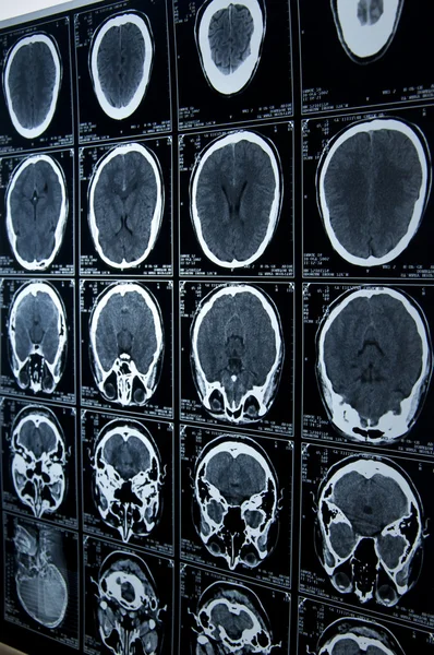 Mri brain scan — Stock Photo, Image