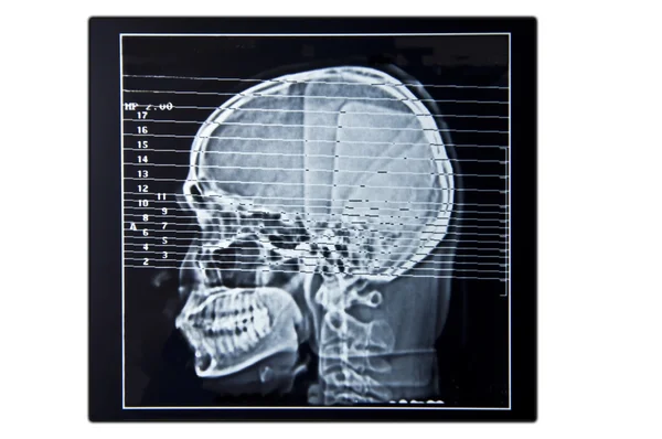 Brain scan film — Stock Photo, Image