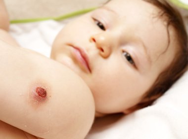 BCG vaccination wound on shoulder clipart