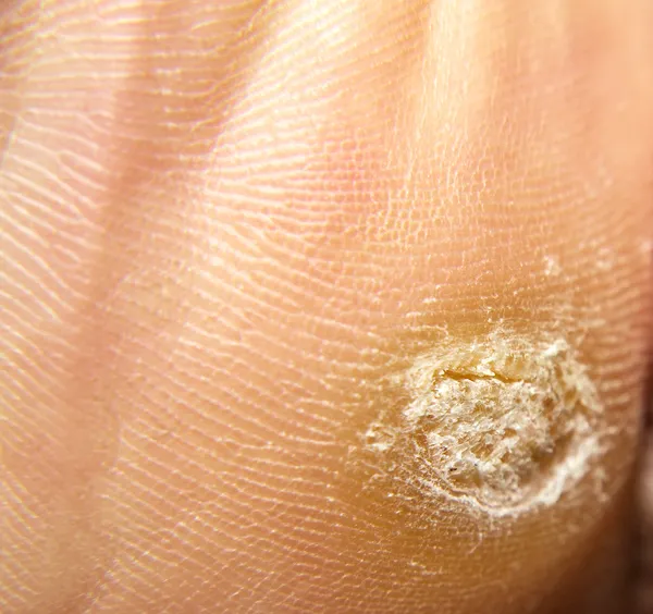 Eelt en hyperkeratosis op voeten — Stockfoto