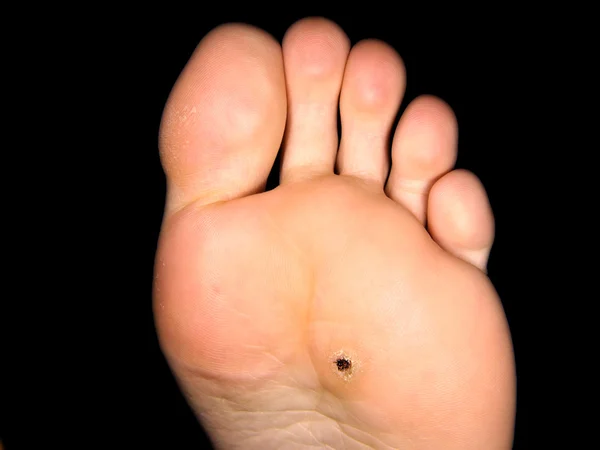 Callus under foot — Stock Photo, Image