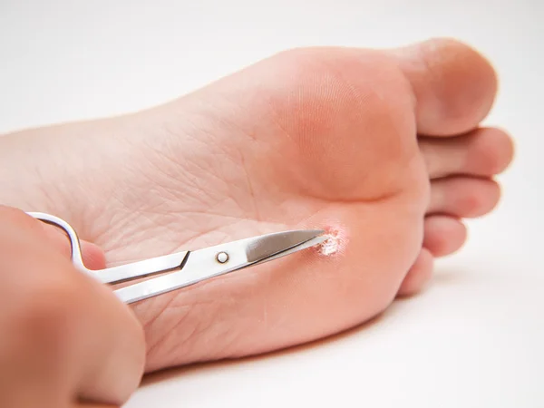 Callus under foot — Stock Photo, Image