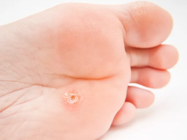 Callus under foot — Stock Photo, Image