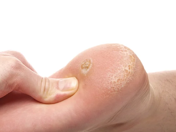 Dry skin under foot — Stock Photo, Image