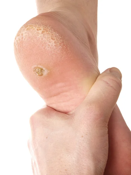 Dry skin under foot — Stock Photo, Image