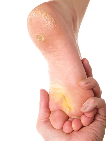 Dry skin under foot — Stock Photo, Image