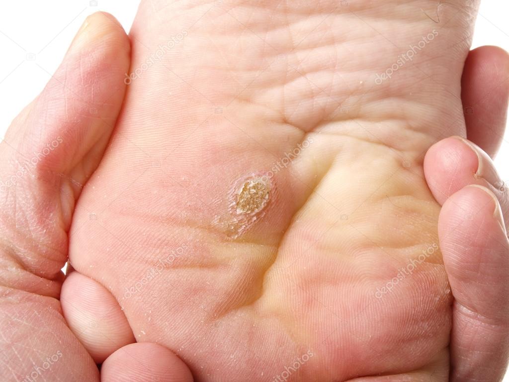 Dry Skin Under Foot Stock Photo Image By C Ab Photostudio 42865371