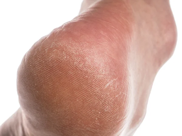 Dry skin on heel — Stock Photo, Image