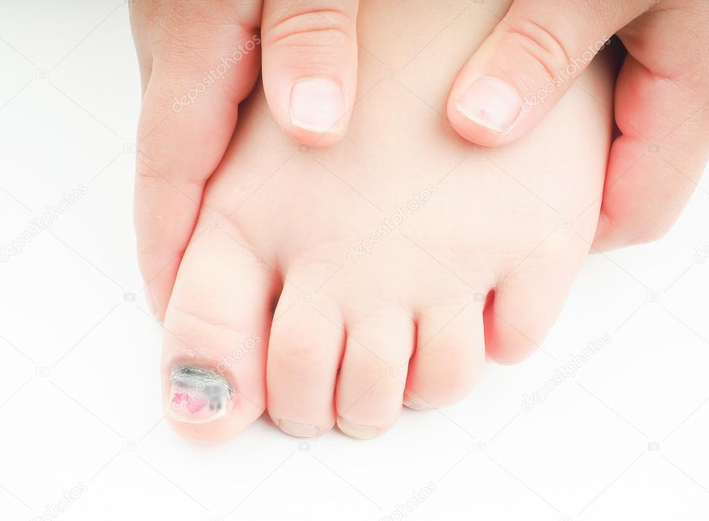 Little girl with a blue nail on hallux toe