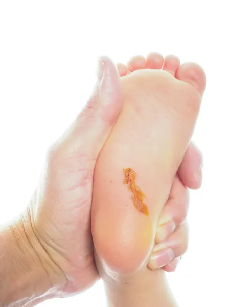 Child with a long cut under foot on heel with antiseptic, being — Stock Photo, Image