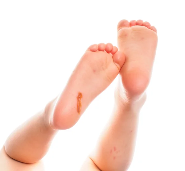 Kind zeigt Füße mit einer frischen Wunde unter der rechten Ferse — Stockfoto