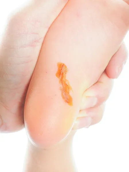 Kind mit einem langen Schnitt unter dem Fuß an der Ferse mit antiseptischem, — Stockfoto
