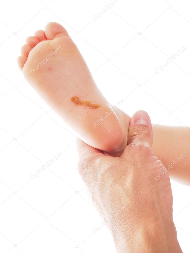 Child with a long cut under foot on heel, being examinated towar