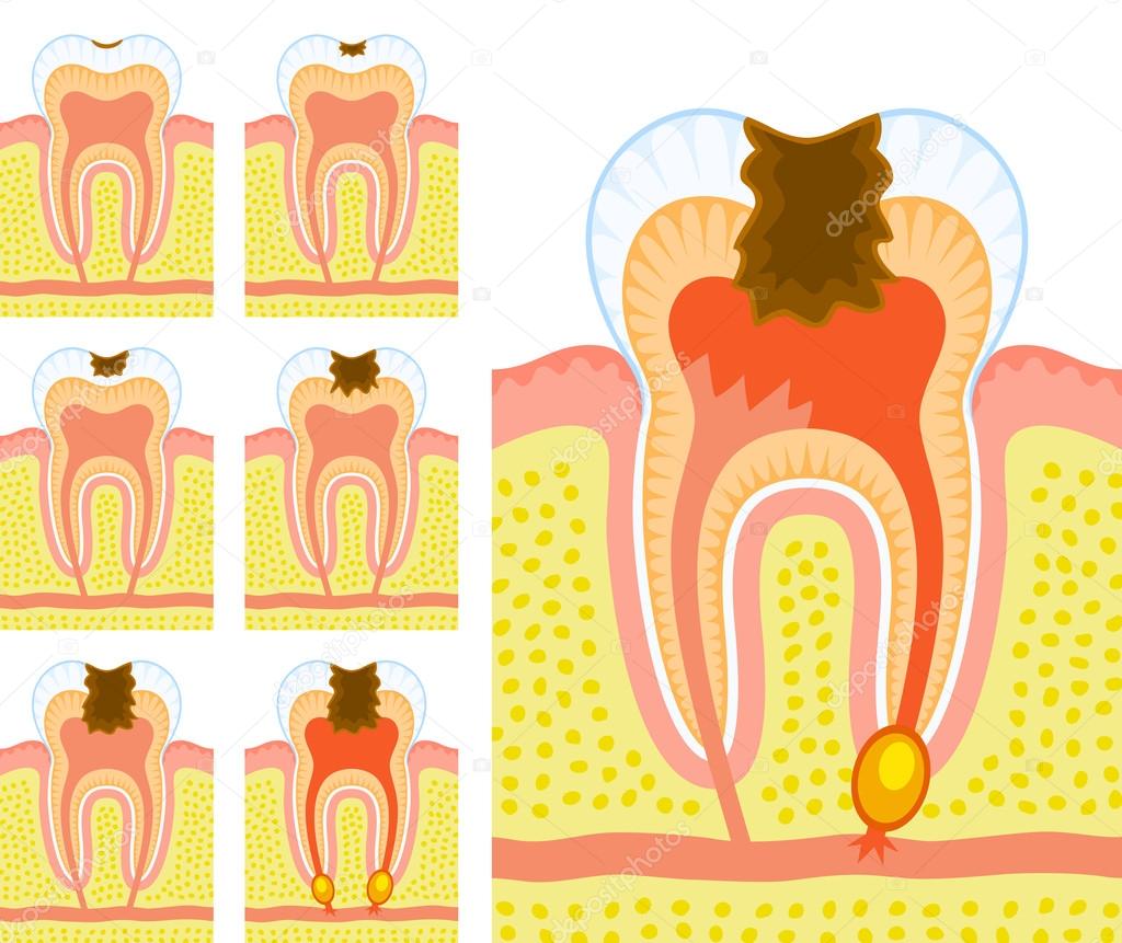 Internal structure of tooth (decay and caries)