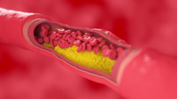Röda blodkroppar rinner genom det kärl som påverkas av kolesterolplack — Stockvideo