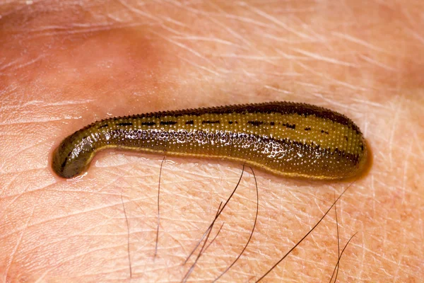 Leech behandeling — Stockfoto