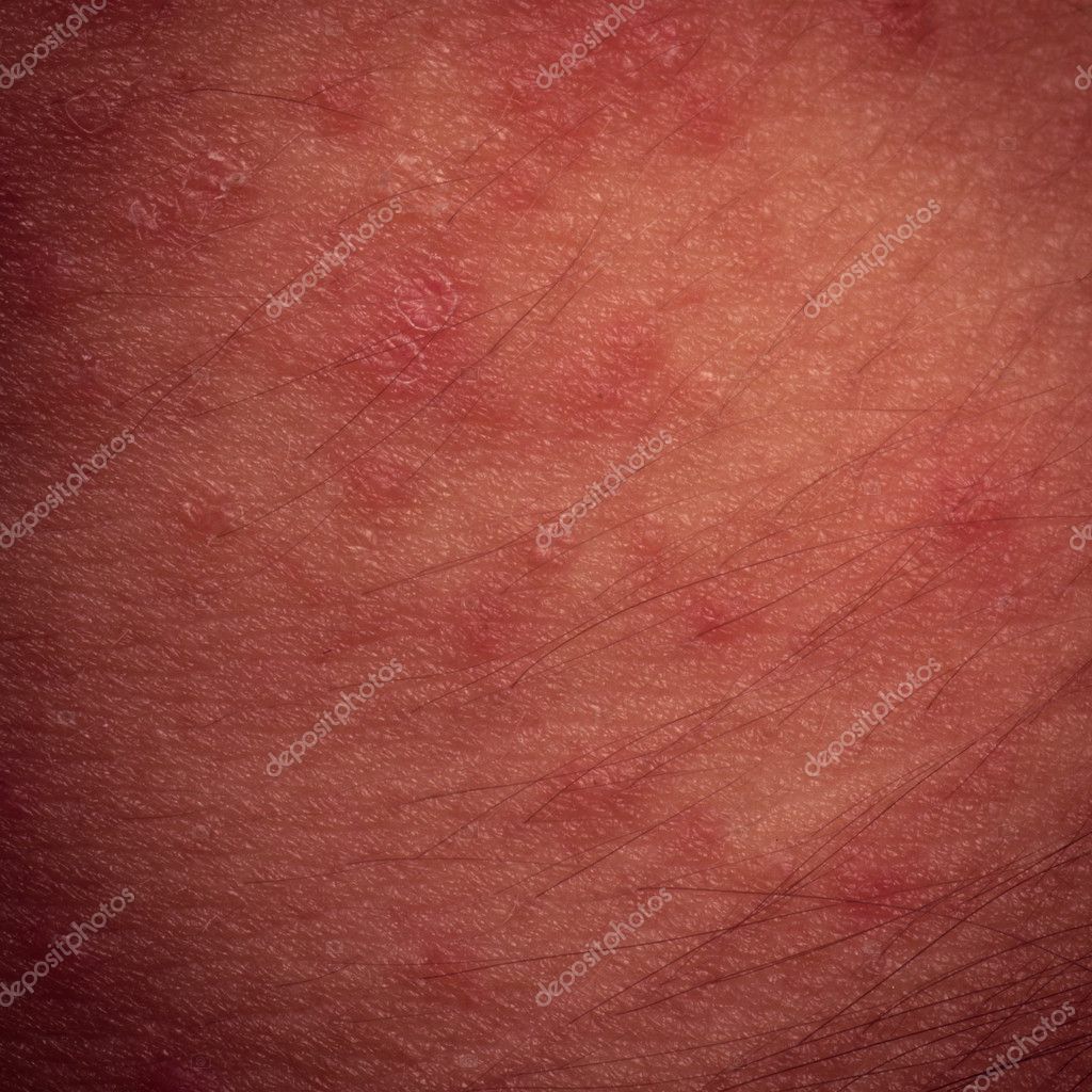Texture De Peau Eczéma Dermatite Atopique Symptôme — Photographie