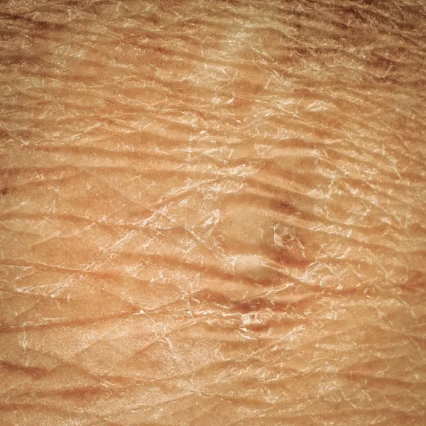 Dry skin texture — Stock Photo, Image