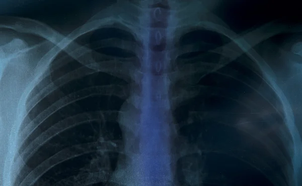 X-ray of chest — Stock Photo, Image