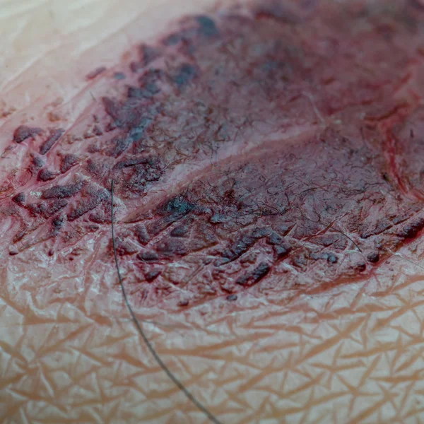 Medical incrustation scab — Stock Photo, Image