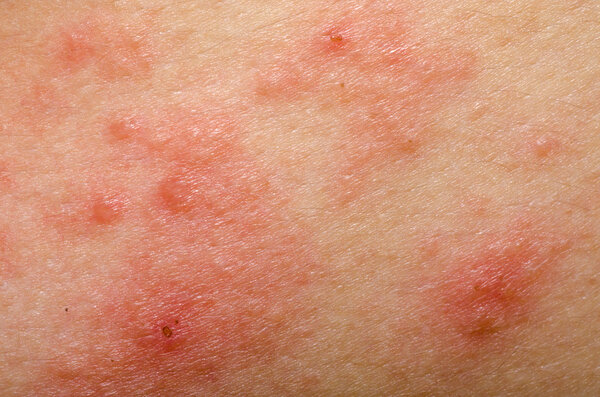 eczema atopic dermatitis symptom skin