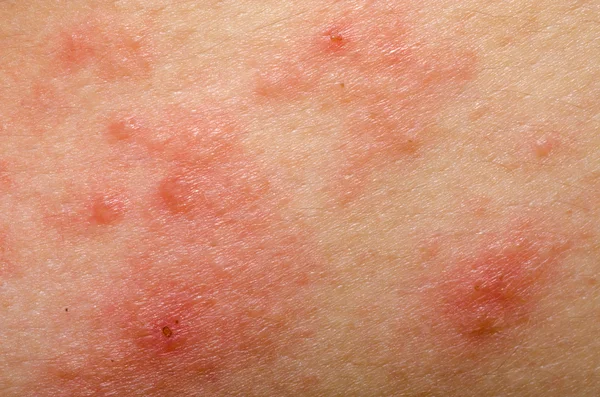 Ekzém Atopická dermatitida příznak pleť Stock Fotografie