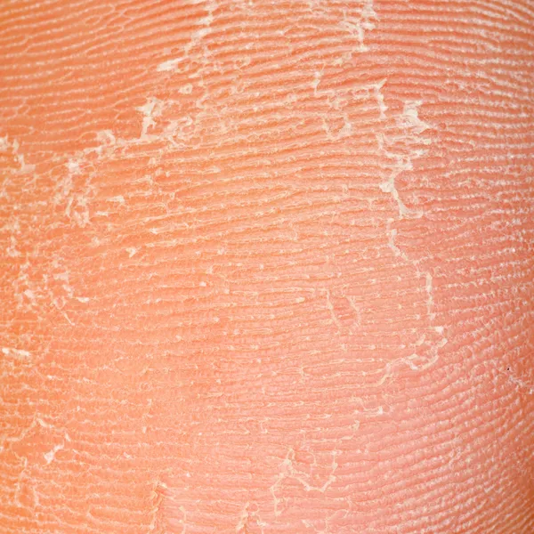 Textur trockener Haut — Stockfoto