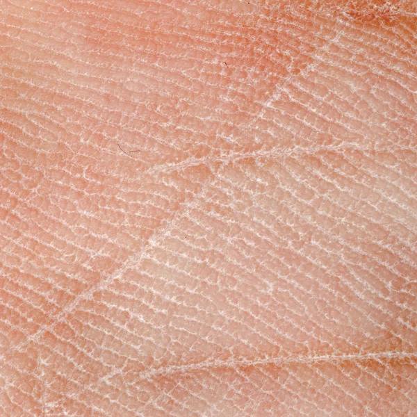 Dry skin texture — Stock Photo, Image