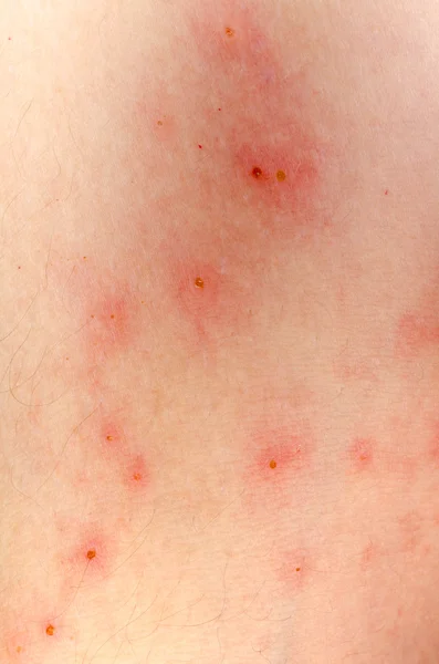Аллергическая сыпь экзема кожи дерматита — стоковое фото