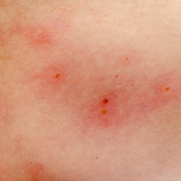 Allergiska utslag dermatit eksem hud — Stockfoto