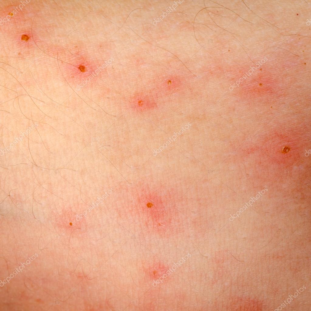 Erupción Alérgica Dermatitis Eccema Piel 2022