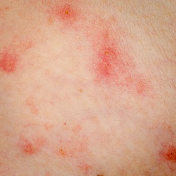 Allergic rash dermatitis eczema skin Stock Picture