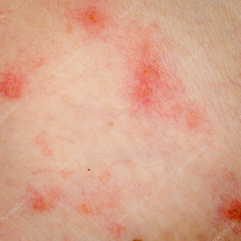 Psoriaznyy el centro en terrible