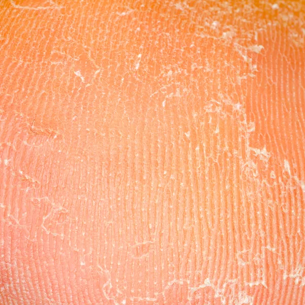 Texture peau sèche — Photo