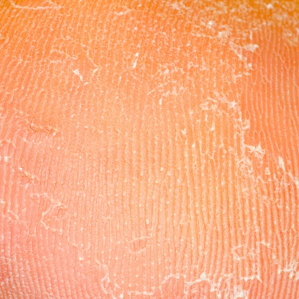 Dry skin texture Royalty Free Stock Photos