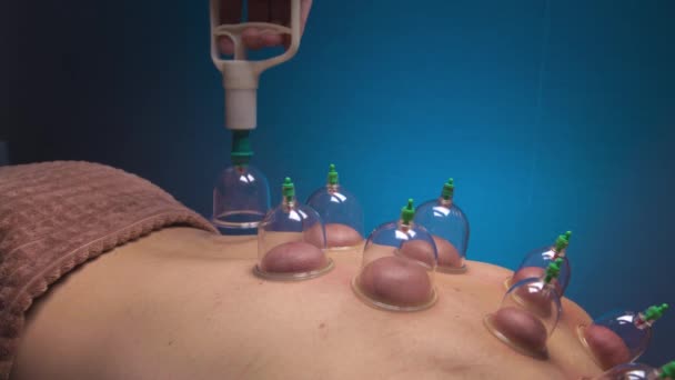 Vacuum massage procedure. Vacuum cans are installed with male hands. Close-up of vascular treatment on the surface of the back — Stock videók