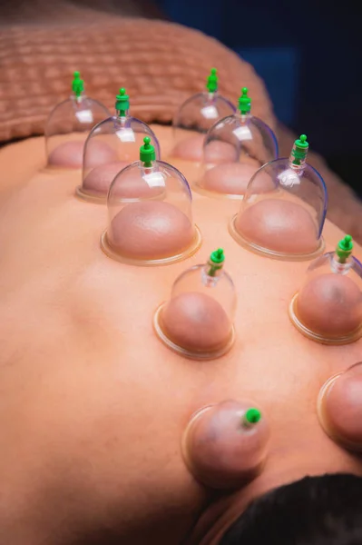 Man lying down recovering health with vacuum cups. Close-up of vacuum cups on the back of a man against a black-blue background. Traditional oriental medicine.