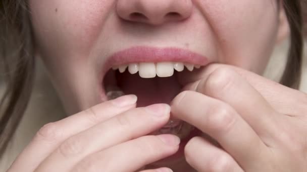 Mouth Close-up Młoda kobieta kładzie korekcyjną szynę wyrównawczą na dolnych zębach, aby skorygować zgryz patrząc w lustro w łazience. Instalacja wyrównujących — Wideo stockowe