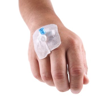 intravenöz kanül, erkekler el üzerinde kurulan venflon