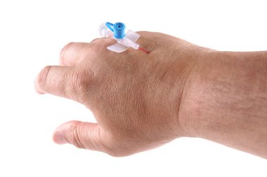 intravenöz kanül, erkekler el üzerinde kurulan venflon
