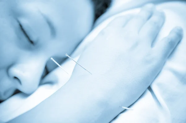 Akupunktur iğneleri kol boyunca sabırlı — Stok fotoğraf