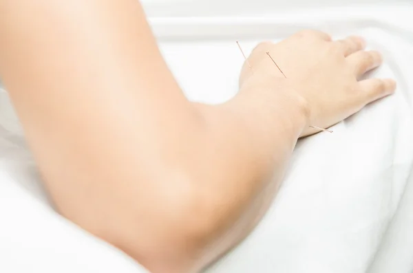 Acupuncture patient with needles along arm — Stock Photo, Image