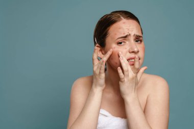 Kızıl saçlı, havluyla yüzünü sıkan genç bir kadın mavi arka planda izole edilmiş sivilceler.