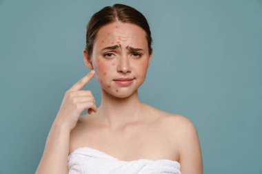 Havluyla gezen kızıl kadın mavi arka plandaki sivilcelerine işaret ediyor.