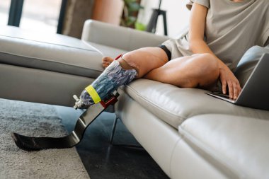 Genç, sakat, protez bacaklı bir kadın evinde dizüstü bilgisayarla kanepede oturuyor.