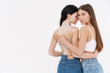 İç çamaşırlı iki genç kadın, beyaz arka plan vitiligo deri kavramının üzerinde soyutlanmış bir şekilde birbirlerine sarılıyorlar.