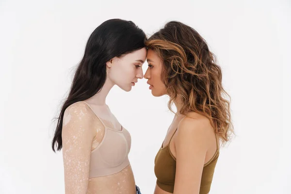二人の若いです女性で下着立って一緒に取り込み絶縁上の白い背景Vitiligo肌の概念 — ストック写真