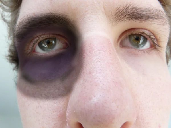 Black eye — Stock Photo, Image