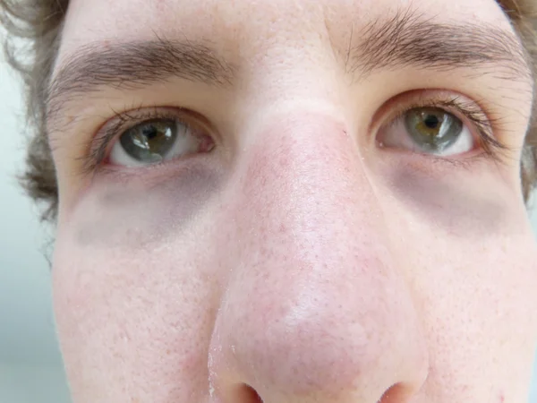 Black eye — Stock Photo, Image