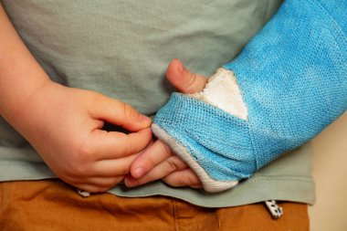 Close-up of a broken hand blue plaster cast after accident torching fringes from another palm